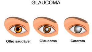 Fazer exame oftalmológico anualmente previne o glaucoma e outras doenças oculares